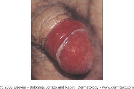 Έκζεμα – Δερματίτιδα εξ επαφής – σμηγματορροϊκή δερματίτιδα