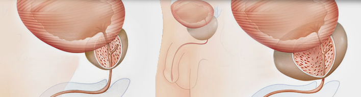 prostate one lobe larger csípő dysplasia egy éves kezelés után