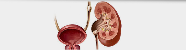 prostatitis urolithiasis